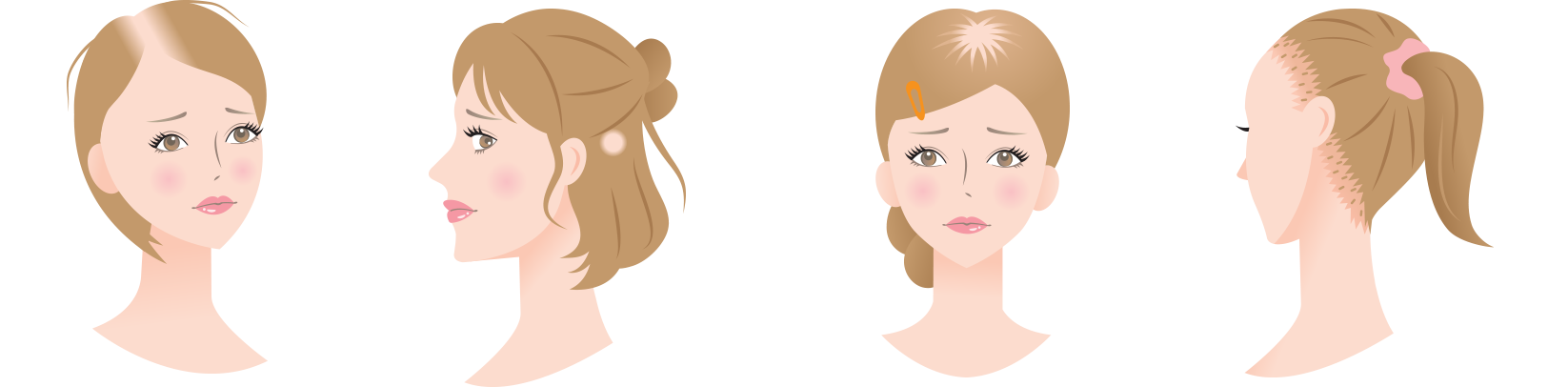女性の薄毛、抜け毛