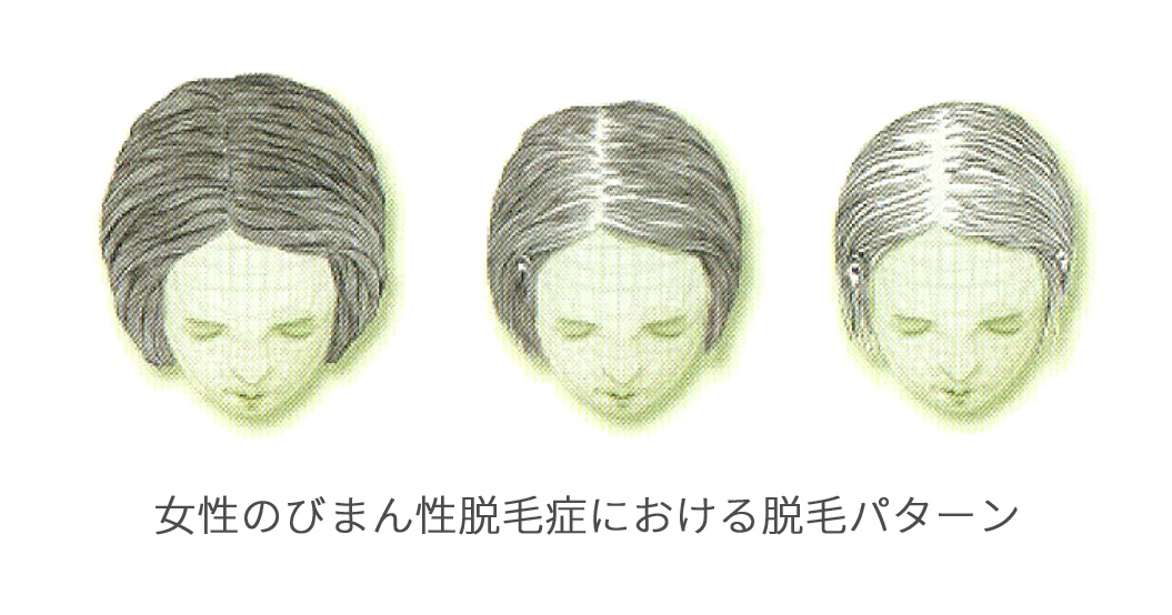 女性のびまん性脱毛症における脱毛パターン