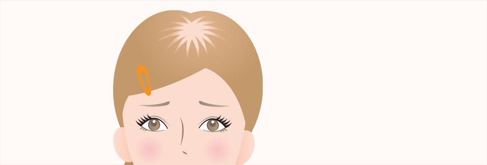 批糠(ひこう)性脱毛症